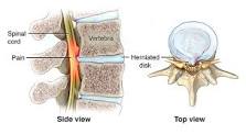 Image result for icd-10 code for cervical cord compression with myelopathy