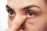  กระเพราแเดง กับเบาหวานขึ้นตาพ่อเบาหวานขึ้นตา ความดัน เบาหวาน โรคหลอดเลือดหัวใจตีบ ค่ะ ตอนนี้ตาเริ่มมัวเพราะเบาหวานขึ้นตา (เลเซอร์ตา23 ต.ค 58) ได้ดูรายการชีวิต ชีวา (ออกอากาศเมื่อ25ต.ค.58) บอกว่ากระเพราแดงจะช่วยเรื่องตาที่เกิดจากเบาหวานขึ้นตาได้ค่ะ เลยให้