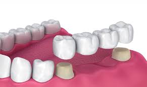 top 4 benefits of dental bridges