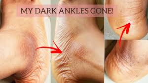 dark ankles clearskin skincare