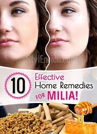 home remes for milia how to treat