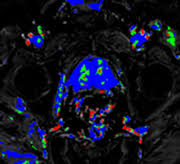 Diagnostic Imaging Prostate Mri