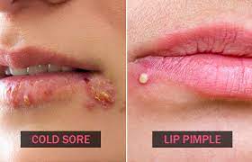 cold sores vs pimples what do you