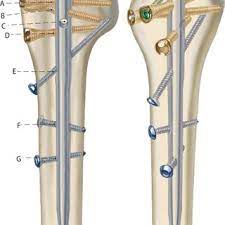 8 proximal humeral nail multiloc