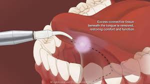 what is frenectomy its types