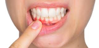 gingivitis how to spot it and more