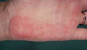 Palmar erythema may occur in about 30 to 60 percent of pregnant people. Palmar Erythema Toronto Notes
