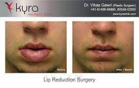 lip reduction surgery in khanna