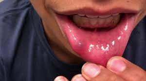 popping a lip cyst mucocele causes