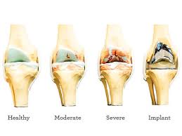 knee replacement pain guide