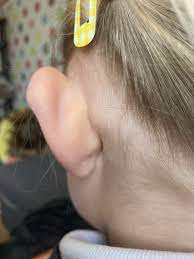 lump behind daughters ear mumsnet