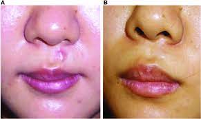 case 1 upper lip hypertrophic scar a