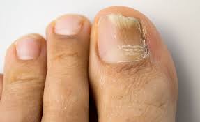 causes and treatments of toenail fungus