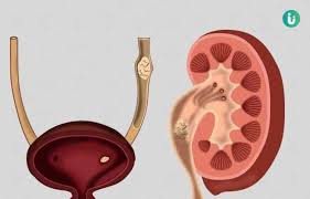 Kidney Stones Diet Foods To Eat And Foods To Avoid If You