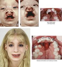 33 cleft orthognathic surgery the