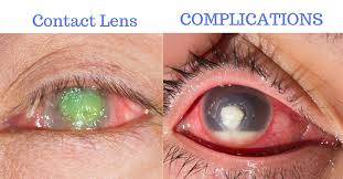 complications of contact lenses board