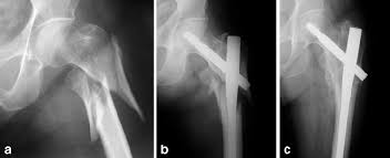 reverse oblique trochanteric fracture