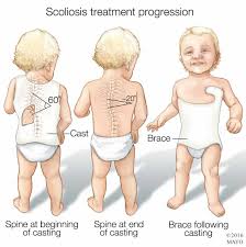 a cal ilration of scoliosis treatment progression in a child