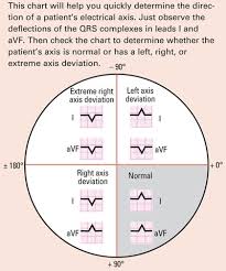 Understanding Axis Deviation Nursing2015