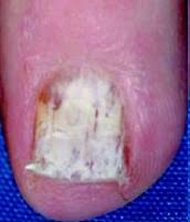 common nail disorders refhelp