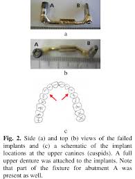 single dental implant components