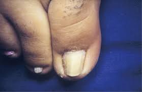 pincer nail deformity clinical