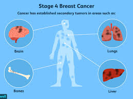Where Breast Cancer Spreads Common Sites Of Metastasis