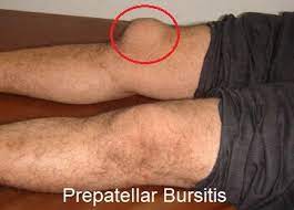 prepatellar bursitis treatment for