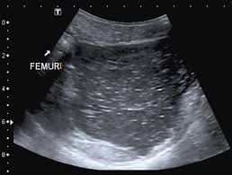 lipoma intermuscular ultrasound in
