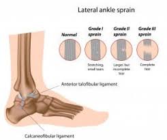 ankle sprains and treatments for a