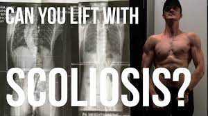 with scoliosis spinal fusion