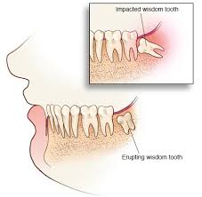 Maybe you would like to learn more about one of these? Wisdom Teeth Veneers Dental Implants Invisible Braces In Sydney