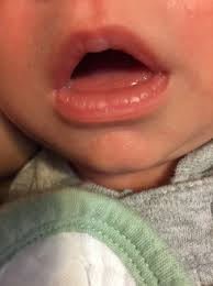 puffy lips after tfeeding babycenter