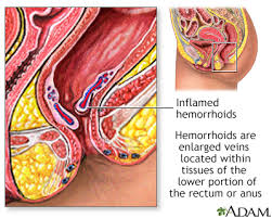 rectal bleeding information mount