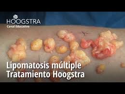 multiple lipomas removed with small