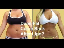 does fat come back after liposuction