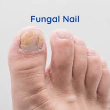 fungal nail cleveland foot and ankle