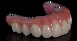 fixed traditional hybrid roe dental