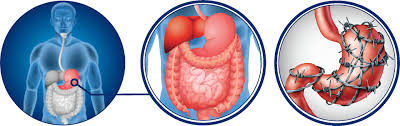 stomach ulcers