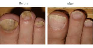 toenail fungus treatment