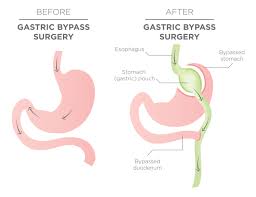 gastric byp surgery procedure and costs
