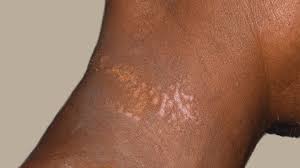 causes of summertime rashes