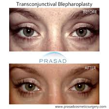 transconjunctival blepharoplasty