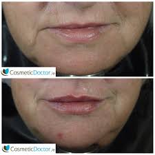 lip fillers are natural results