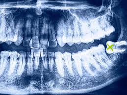 impacted wisdom teeth symptoms and removal