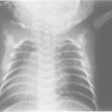 Maybe you would like to learn more about one of these? Ap Supine Chest X Ray Ofcase 1 Showing Dextrocardia And Poorly Formed Ribs Download Scientific Diagram