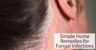 home remes for fungal infection