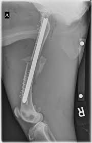 interlocking nail fracture fixation and