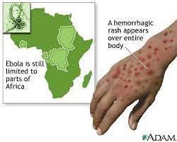 Προστατευθείτε από τη νόσο του ιού έμπολα. Ebola Virus Disease Loimw3h Apo Ton Io Empola Iliaktida