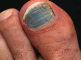 black toenail foot care